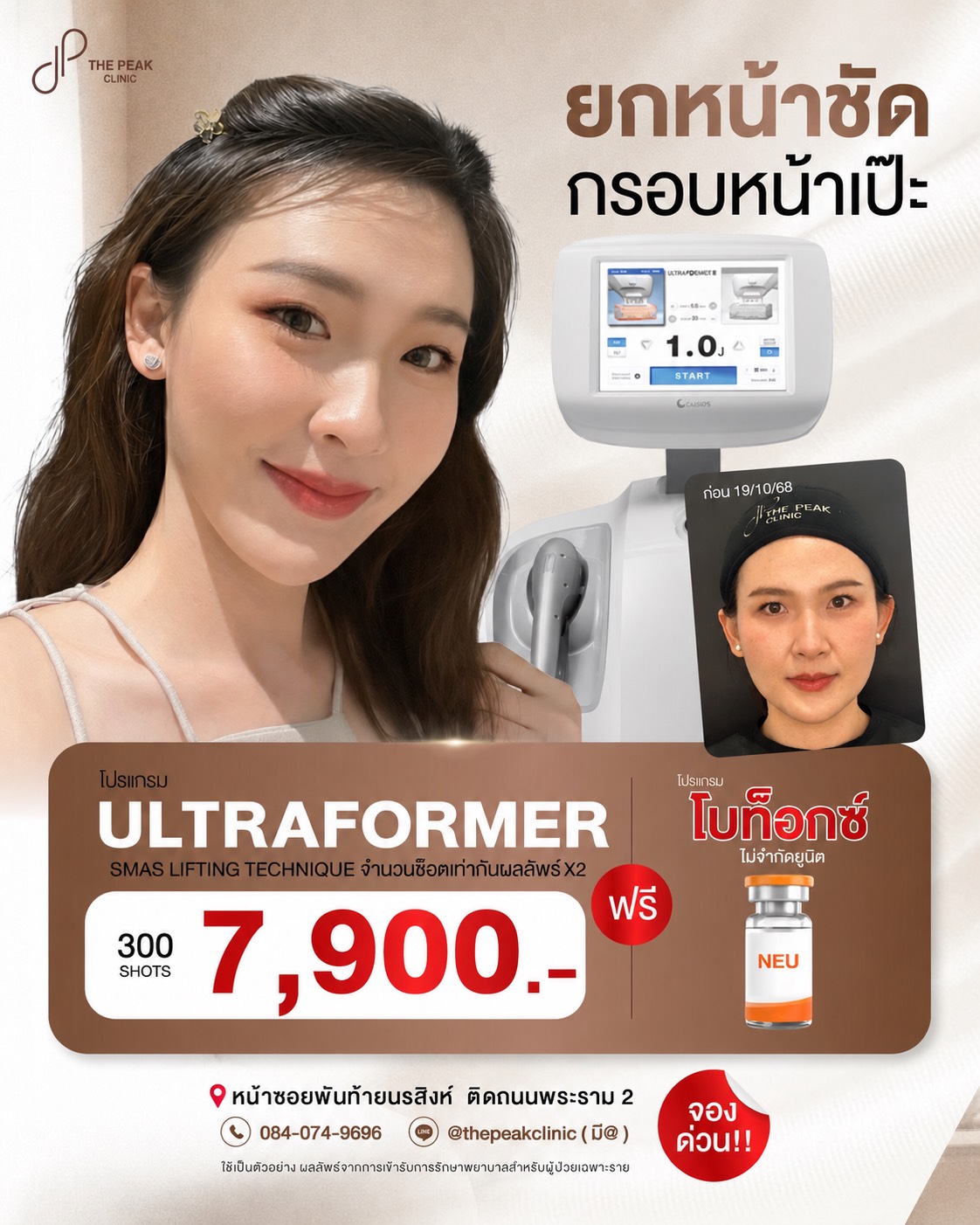 โปรแกรมยกกระชับ ULTRAFORMER III